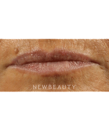 dr-marina-peredo-lip-augmentation-b