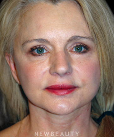 dr-brent-smith-upper-blepharoplasty-necklift-b