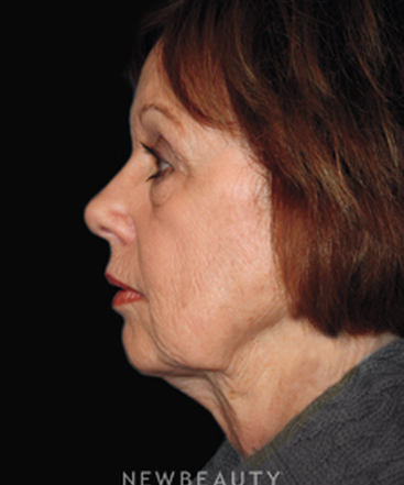 dr-brent-smith-lasers-eye-lift-mini-facelift-b