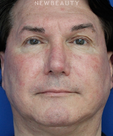 dr-joseph-russo-natural-looking-results-face-ebg-b
