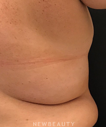 dr-janet-allenby-coolsculpting-b