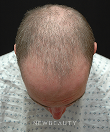 dr-jeffrey-b-wise-hair-loss-b