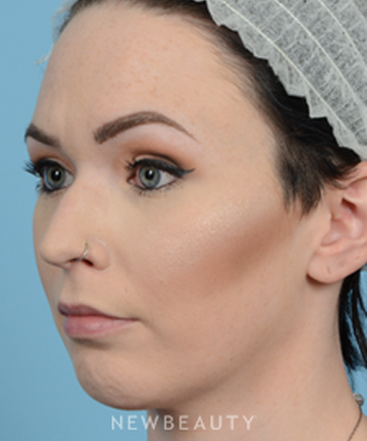 dr-jeffrey-wise-rhinoplasty-b
