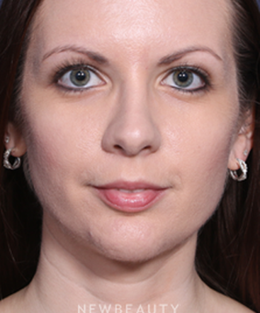 ljcsc-dr-wheeler-rhinoplasty-b