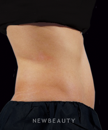 dr-marina-peredo-coolsculpting-b