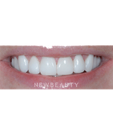 dr-guy-lewis-veneers-b