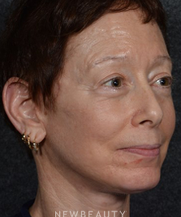 dr-ryan-chastant-facelift-b
