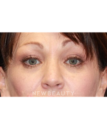 dr-dilip-madnani-upper-blepharoplasty-b