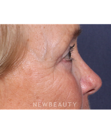 ljcsc-dr-smoot-eyelift-b