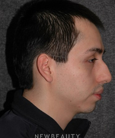 dr-ryan-chastant-rhinoplasty-b