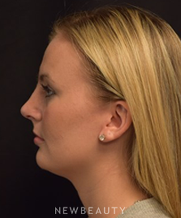 dr-jeffrey-b-wise-rhinoplasty-b