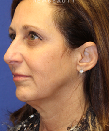 dr-dilip-madnani-facelift-b