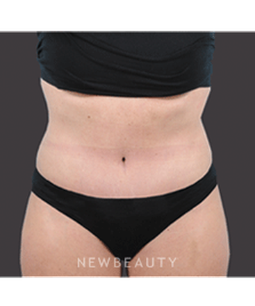 dr-bradley-bengtson-liposuction-tummy-tuck-b