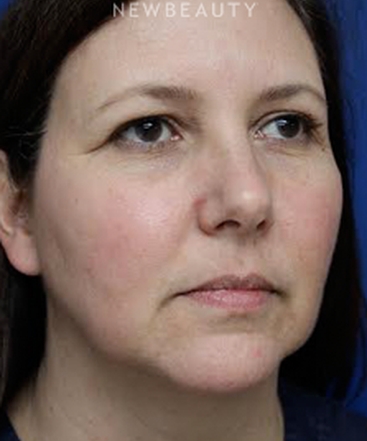 dr-joseph-russo-addressing-facial-aging-face-ebg-b
