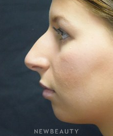dr-jeffrey-b-wise-rhinoplasty-b
