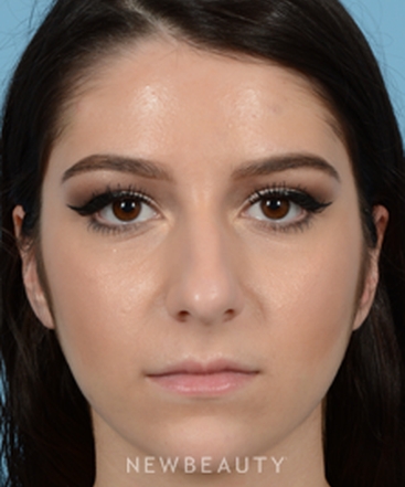 dr-jeffrey-b-wise-rhinoplasty-b