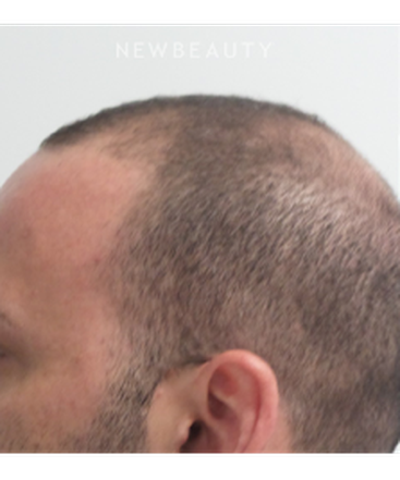 dr-marina-peredo-hair-loss-treatment-b