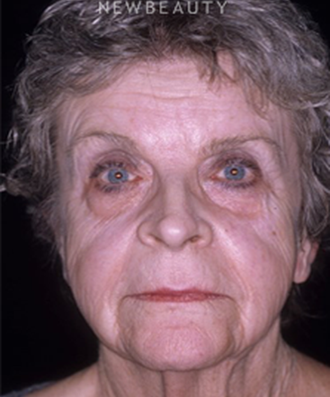 dr-charles-e-crutchfield-botox-b