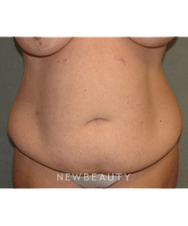 dr-sean-simon-tummy-tuck-lipo-b