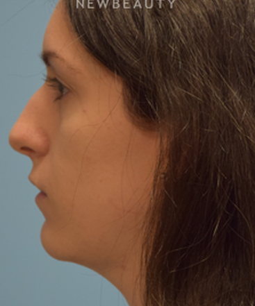 dr-jeffrey-wise-rhinoplasty-b