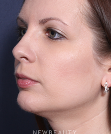 ljcsc-dr-wheeler-rhinoplasty-b