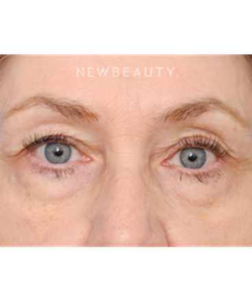 dr-raymond-douglas-blepharoplasty-b