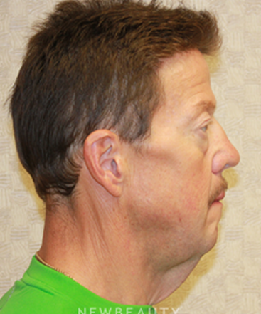 dr-dilip-d-madnani-facelift-necklift-eyelift-b