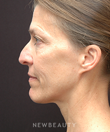dr-jeffrey-b-wise-rhinoplasty-b