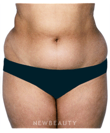 dr-david-rapaport-liposuction-b