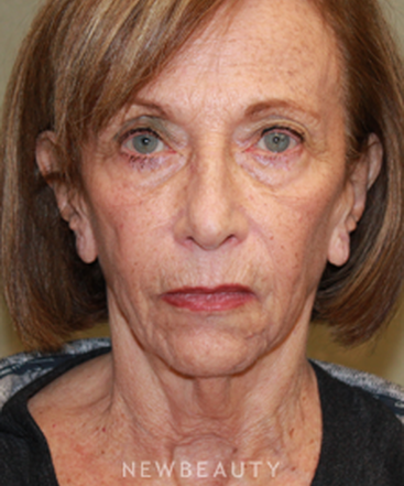 dr-dilip-d-madnani-facelift-necklift-b