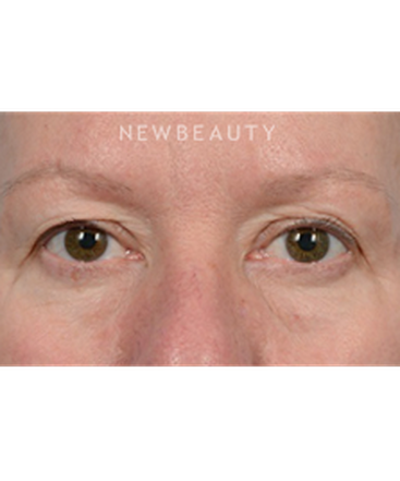 dr-jeffrey-wise-upper-and-lower-blepharoplasty-b