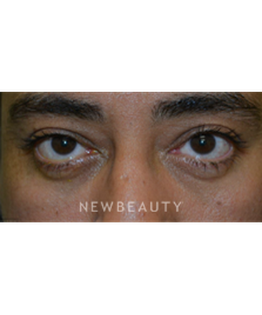 dr-baljeet-k-purewal-blepharoplasty-b