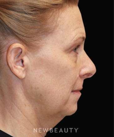 dr-dilip-madnani-facelift-b