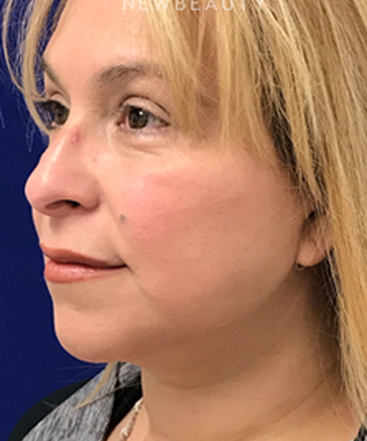 dr-dilip-madnani-facelift-necklift-b