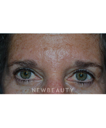 dr-baljeet-purewal-blepharoplasty-b