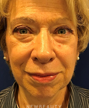 dr-dilip-madnani-facelift-with-fat-transfer-b