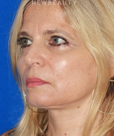 dr-konstantin-vasyukevich-upper-and-lower-blepharoplasties-b