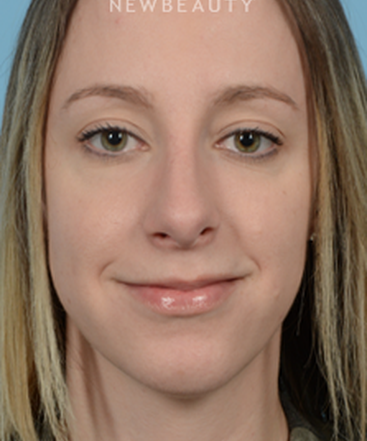 dr-jeffrey-wise-rhinoplasty-b