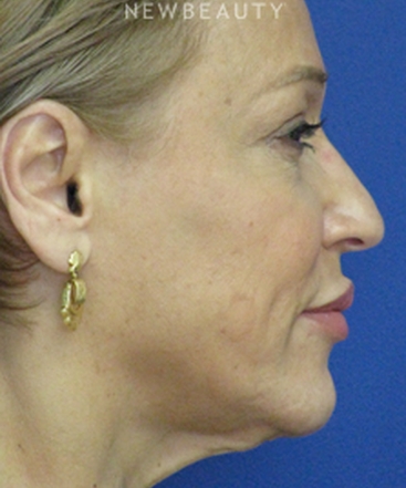 dr-joseph-russo-full-face-rejuvenation-face-ebg-b
