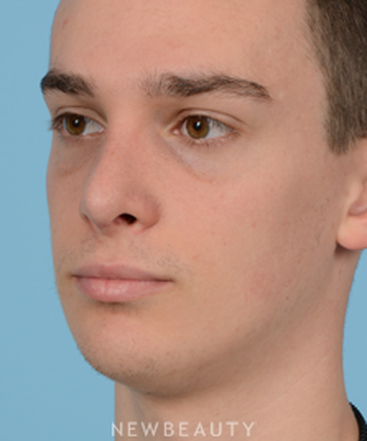 dr-jeffrey-wise-rhinoplasty-b