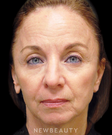 dr-janet-allenby-injectables-b