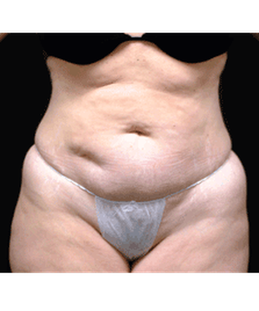 dr-andrew-smith-tummy-tuck-liposuction-b