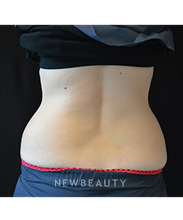 dr-kim-nichols-coolsculpting-b