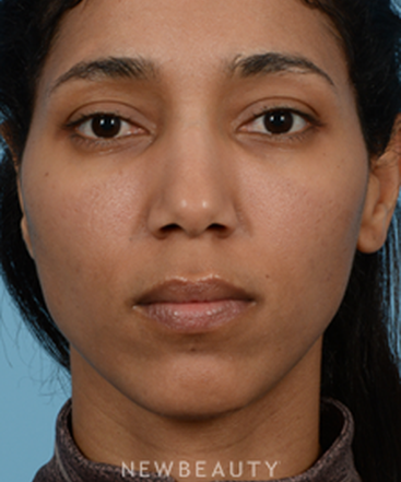 dr-jeffrey-b-wise-nasal-tip-refinement-b