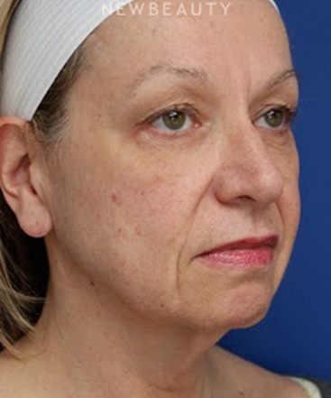 dr-joseph-russo-rejuvenated-look-face-ebg-b
