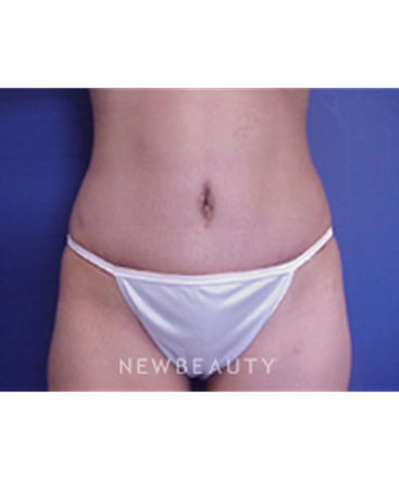 dr-joseph-russo-tummy-tuck-b
