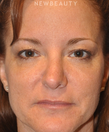 dr-bryan-w-gawley-revision-rhinoplasty-b