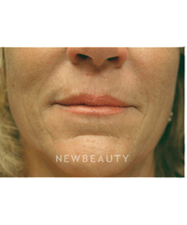 dr-kenneth-beer-injectables-fillers-b