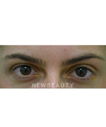 dr-baljeet-purewal-browlift-b