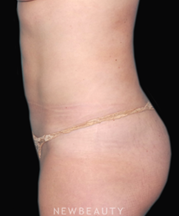 dr-sean-simon-laser-liposuction-b